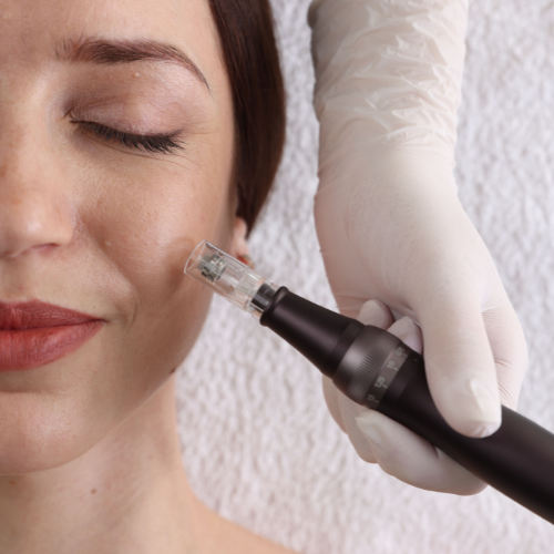 microneedling